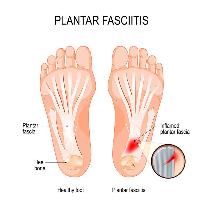 tag image for plantar fasciitis