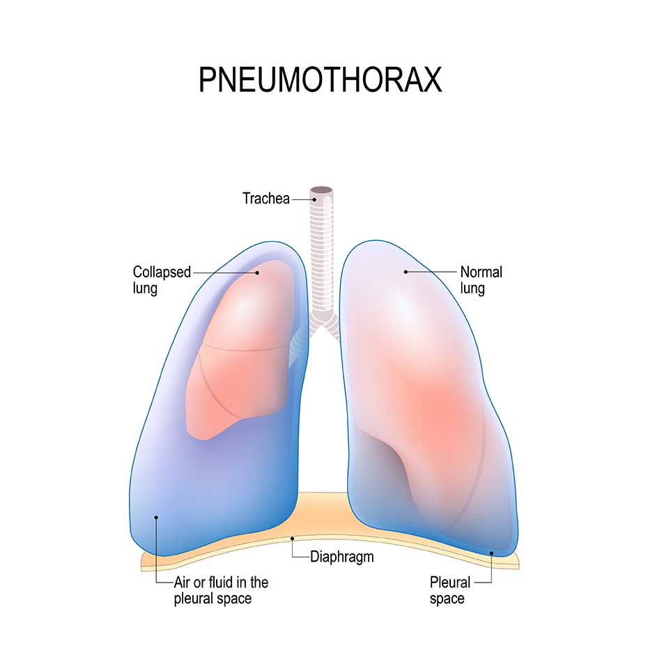 Pneumothorax